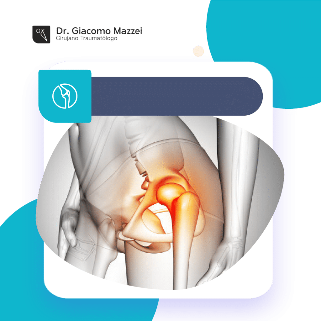 bursitis trocanterica